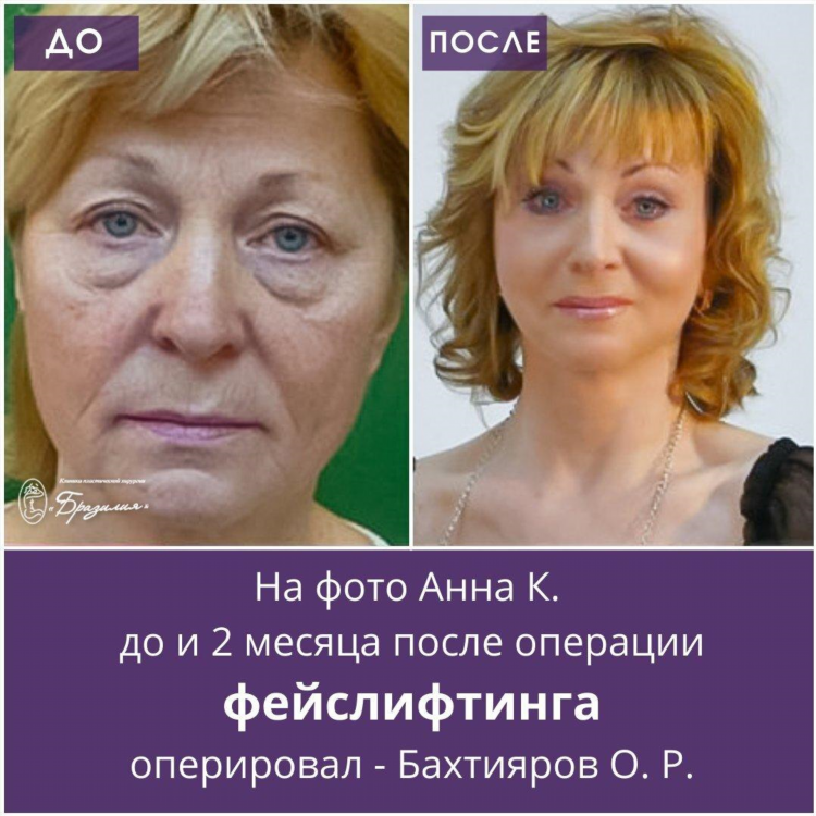 Блефаропластика в калининграде цены